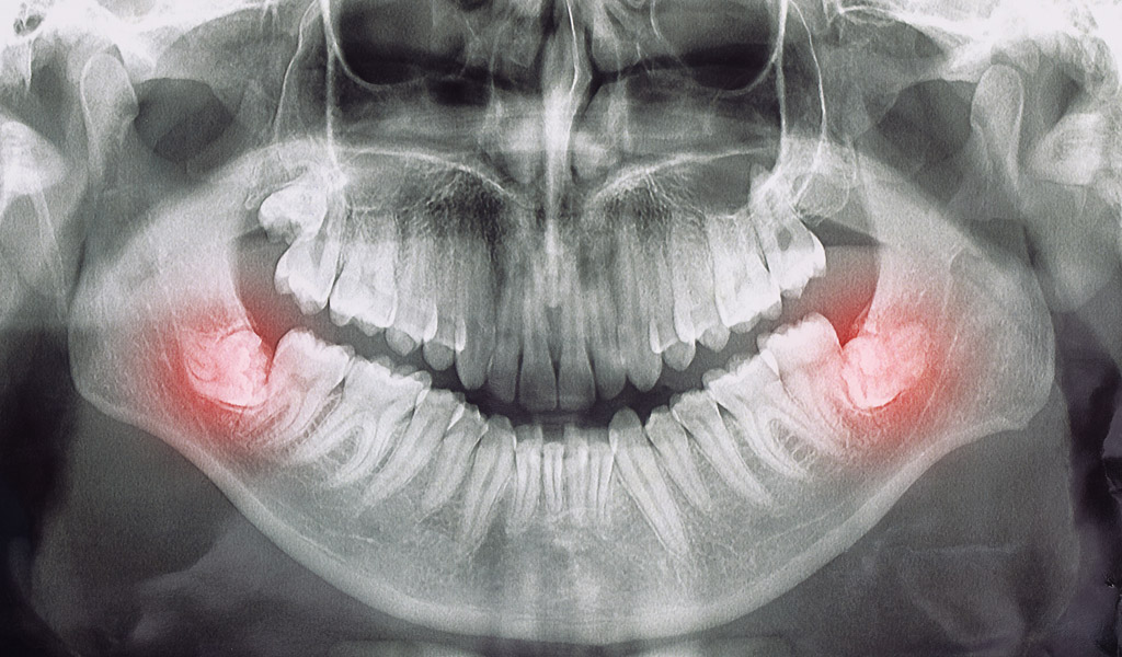 casos difíciles dentales en Mataró