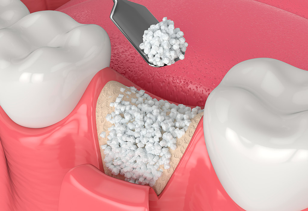 implantes dentales para poco hueso en Mataró