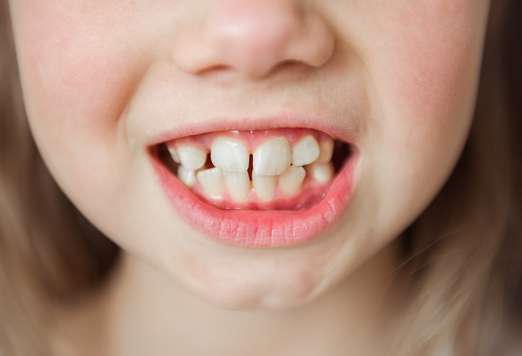 remedios entre espacios dentales